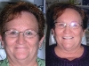 Full mouth restoration