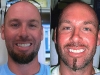 Full mouth restoration