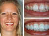 porcelain-veneers-01